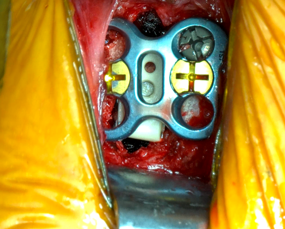 How 3D Visualization Technology Is Transforming Spine Surgery